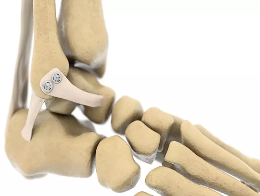 Reparación de tendones y ligamentos
