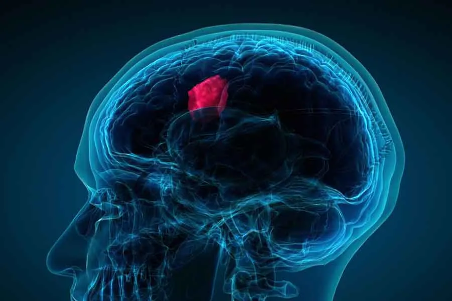 Los tumores cerebrales son crecimientos de células anormales en los tejidos del cerebro .