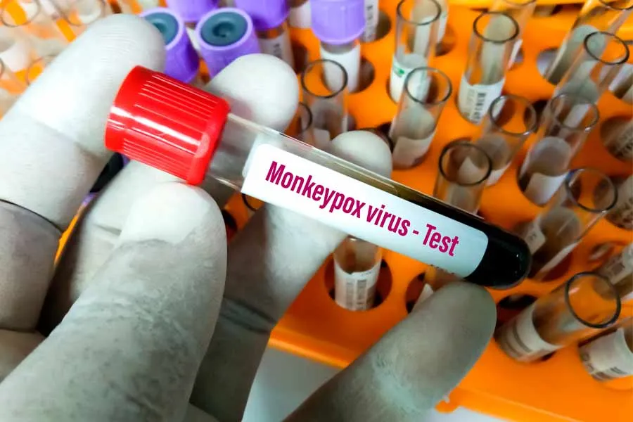 La viruela del mono se puede diagnosticar con tomas de partes infectadas en pruebas PCR.